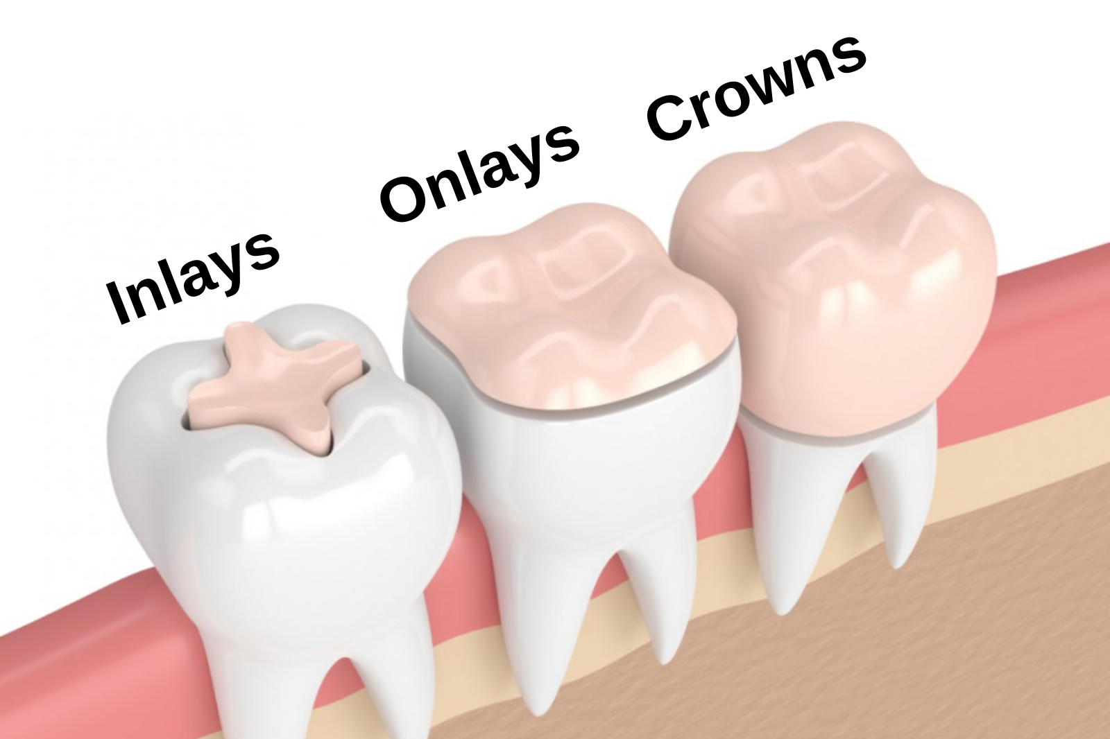 Seramik Onley-Inley Dolgu Uygulaması